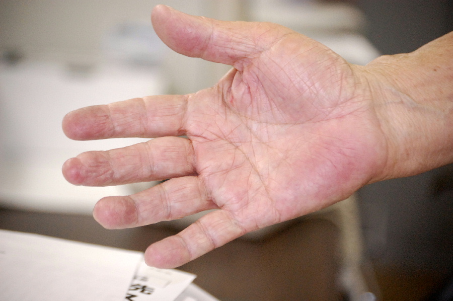 捕虜時代の怪我（本文にある）で中指の先がもげているＮさんの手